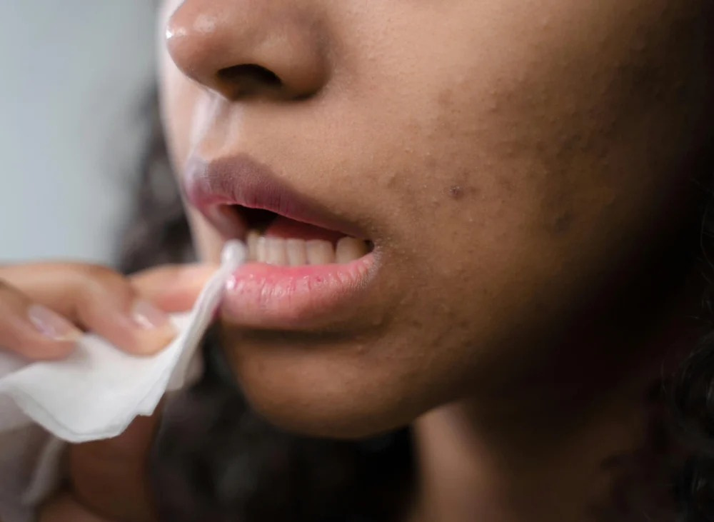 upper lip laser hair removal nyc