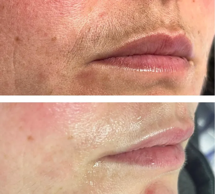 Upper Lip Laser Hair Removal NYC